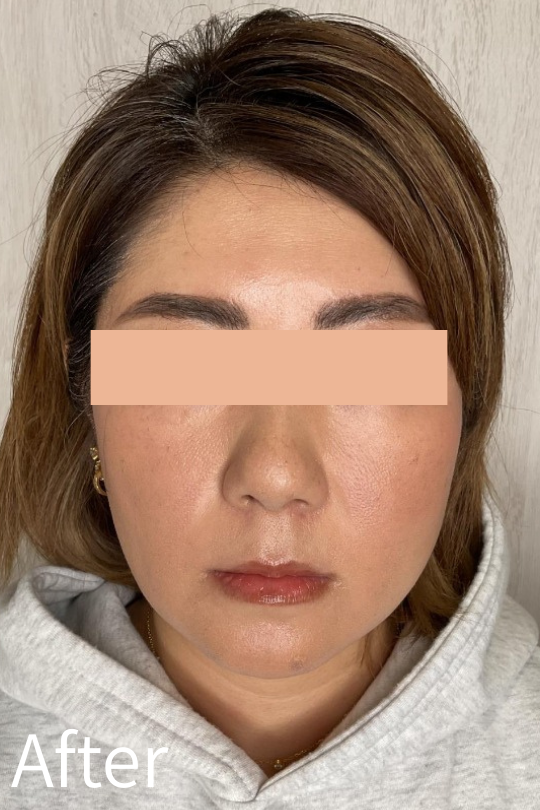 脂肪溶解注射 症例：40代女性 フェイスライン After（1週間後）