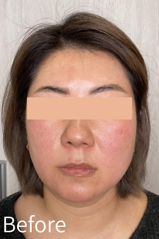 脂肪溶解注射 症例：40代女性 フェイスライン Before